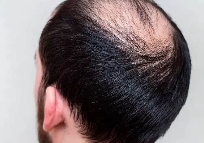 alopecia-androgenetica