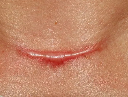 cicatrices