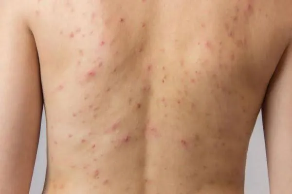 foliculitis