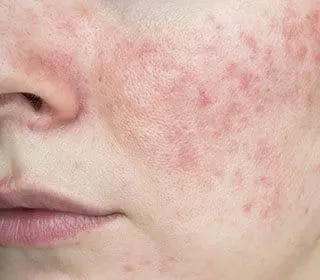 rosacea