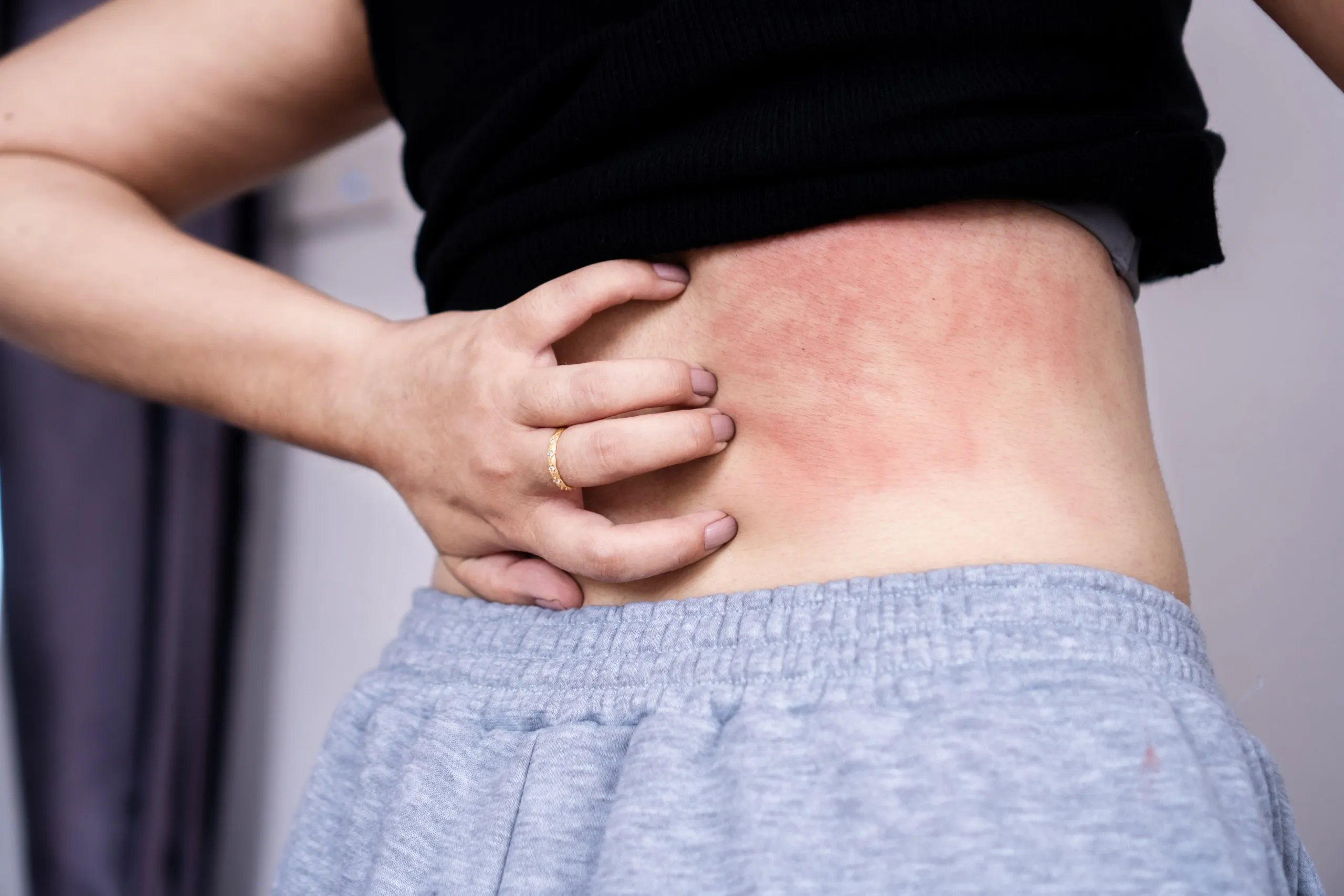urticaria
