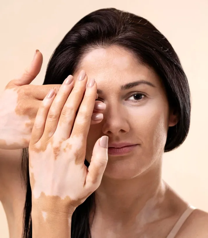 vitiligo