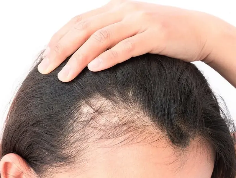 Alopecia por Efluvio Telógeno