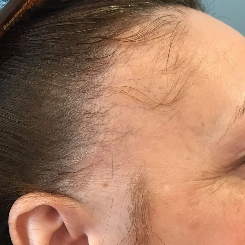 Alopecia Fronto Fibrosante