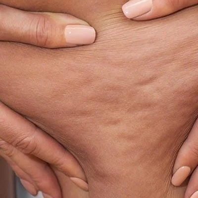Celulitis