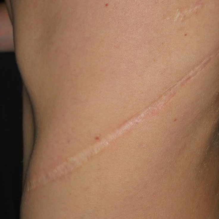 Cicatrices
