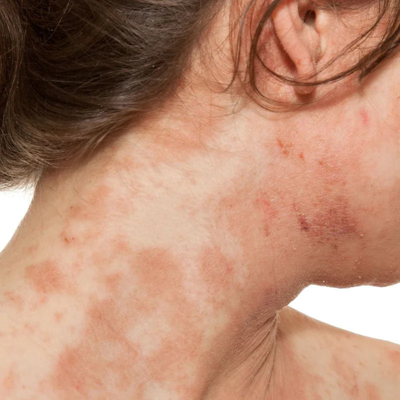 Dermatitis