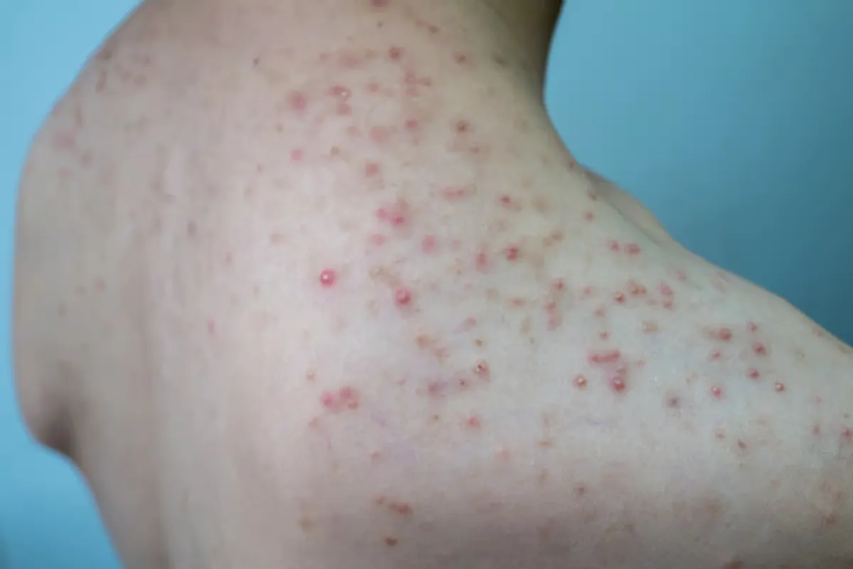 Foliculitis