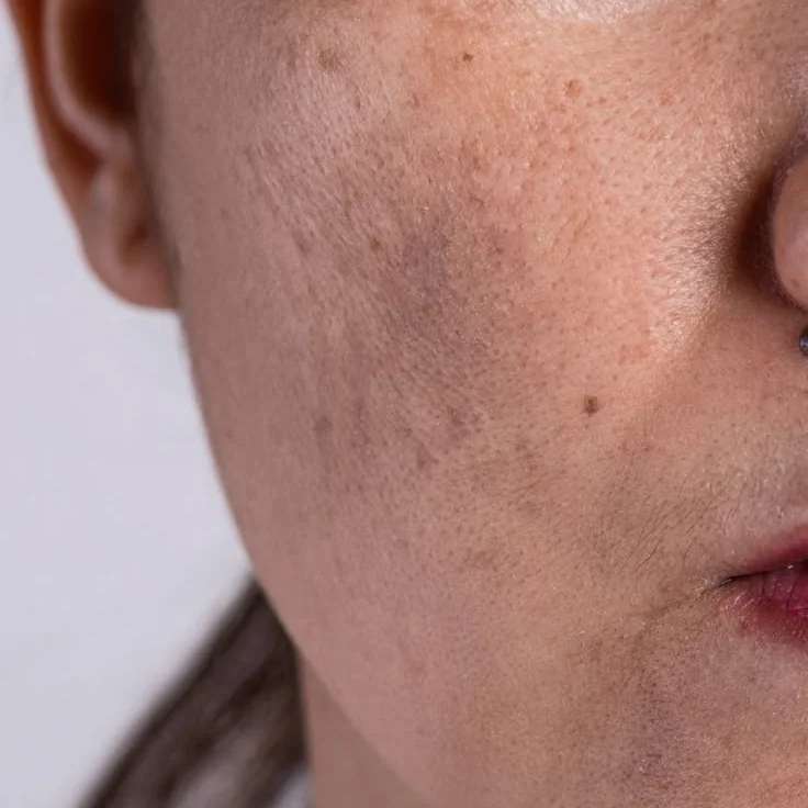 Melasma