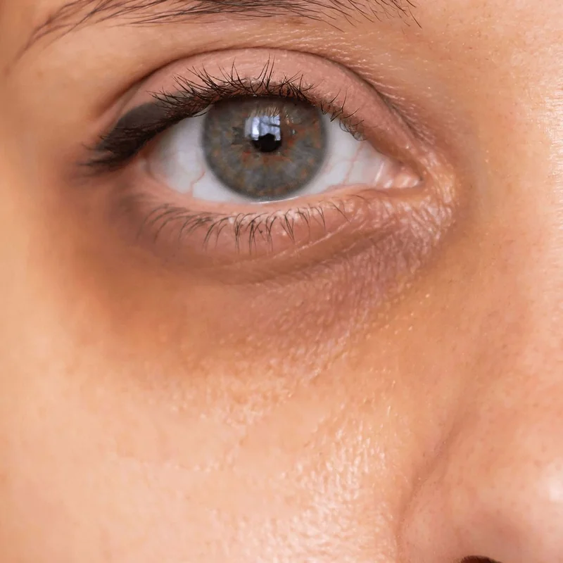 Ojeras