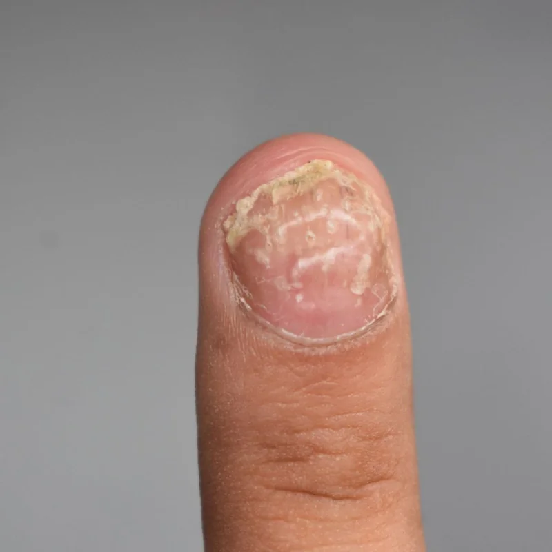 Onicomicosis