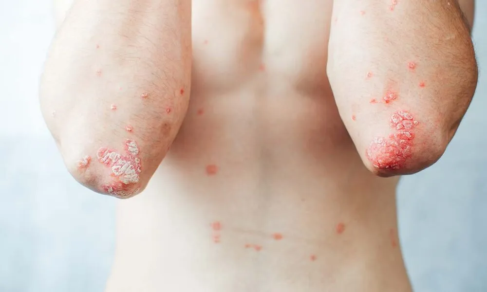 Psoriasis