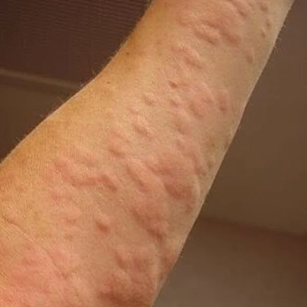 Urticaria